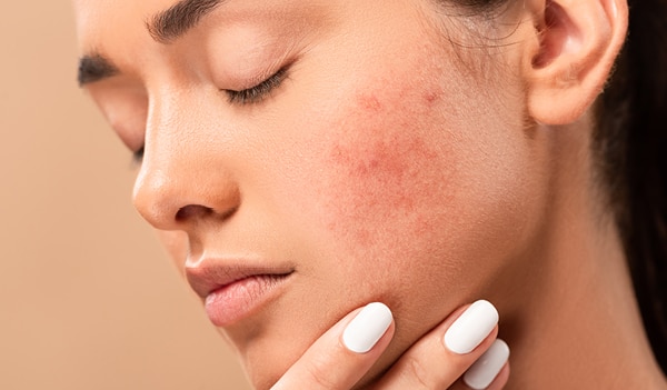 best vitamins for acne-prone skin
