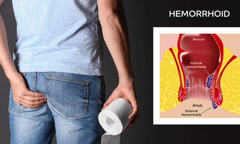 Dangers of hemorrhoid