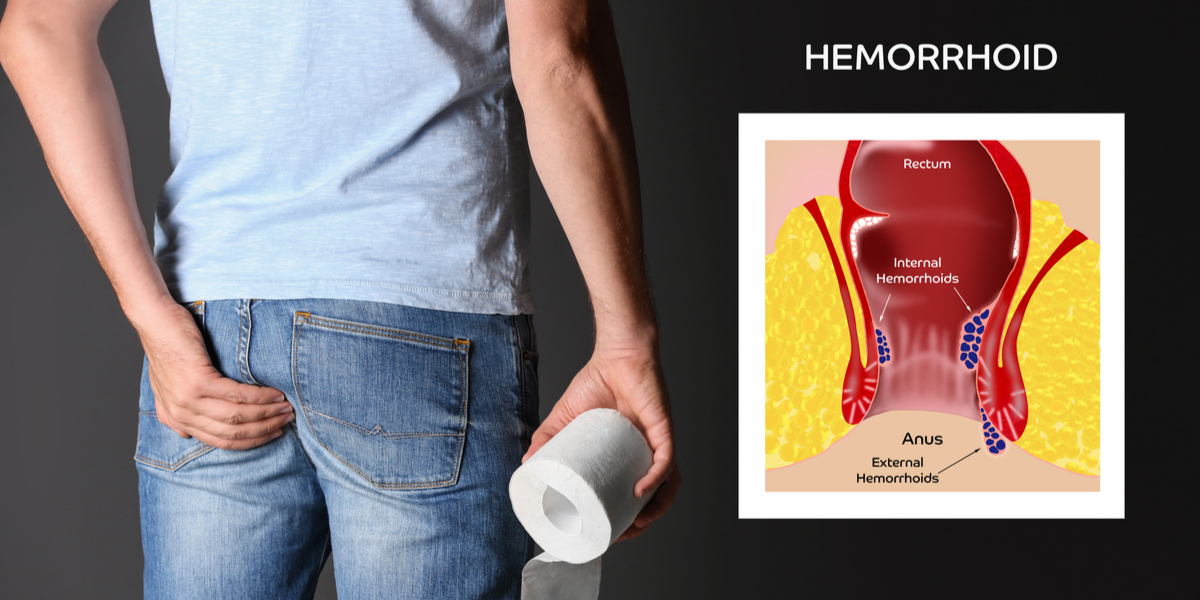 Dangers of hemorrhoid