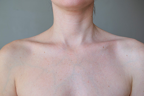 blue veins on the boobs