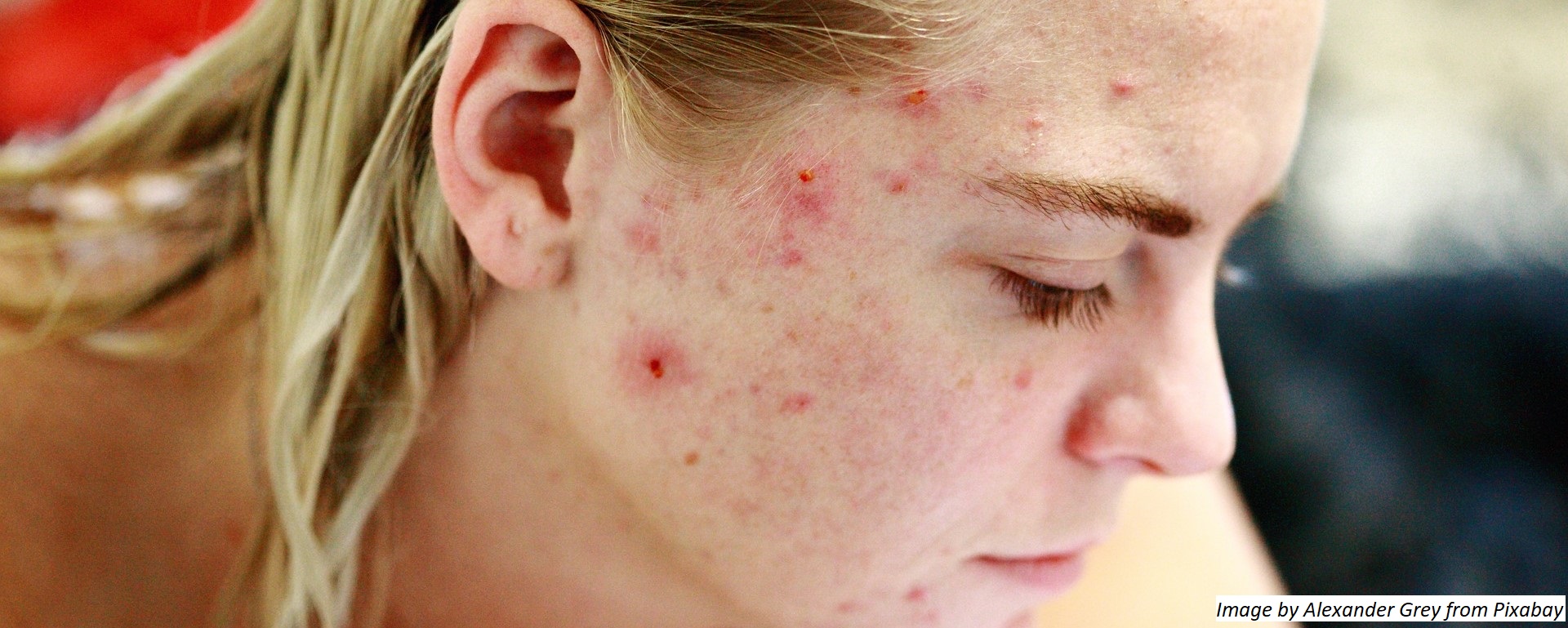 what is acne actually?